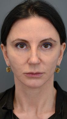 Ponytail Facelift before and after, case 15 (before)