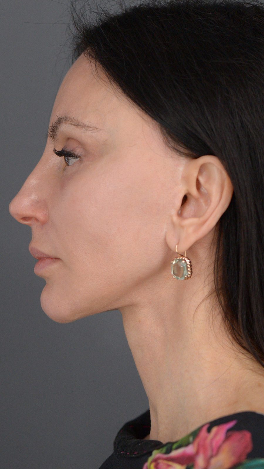 Ponytail Facelift before and after, case 15, view 10 (after)