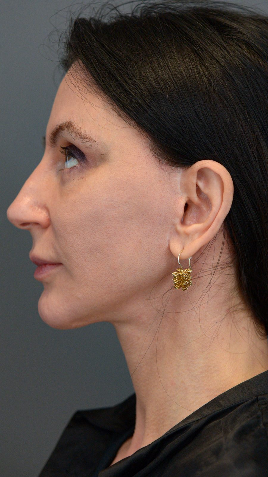 Ponytail Facelift before and after, case 15, view 10 (before)