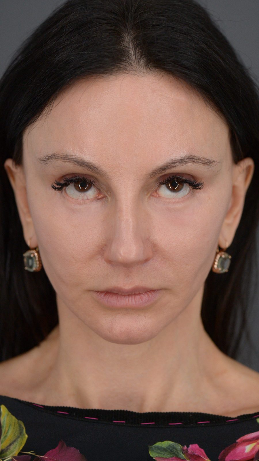 Ponytail Facelift before and after, case 15, view 3 (after)