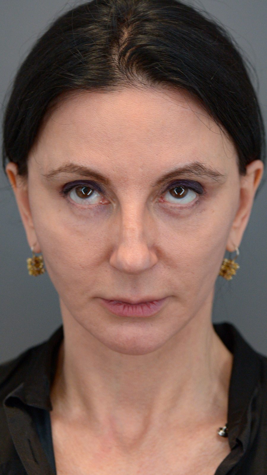 Ponytail Facelift before and after, case 15, view 3 (before)