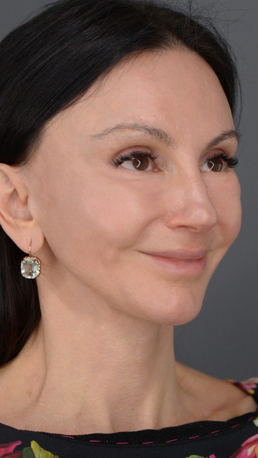 Ponytail Facelift before and after, case 15, view 4 (after)