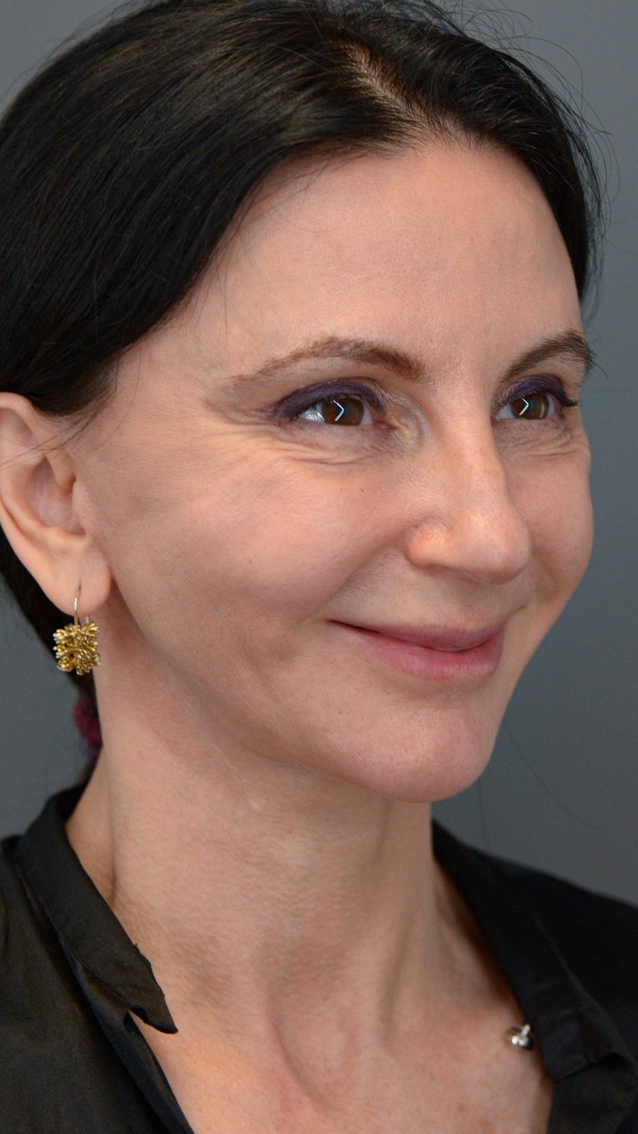 Ponytail Facelift before and after, case 15, view 4 (before)
