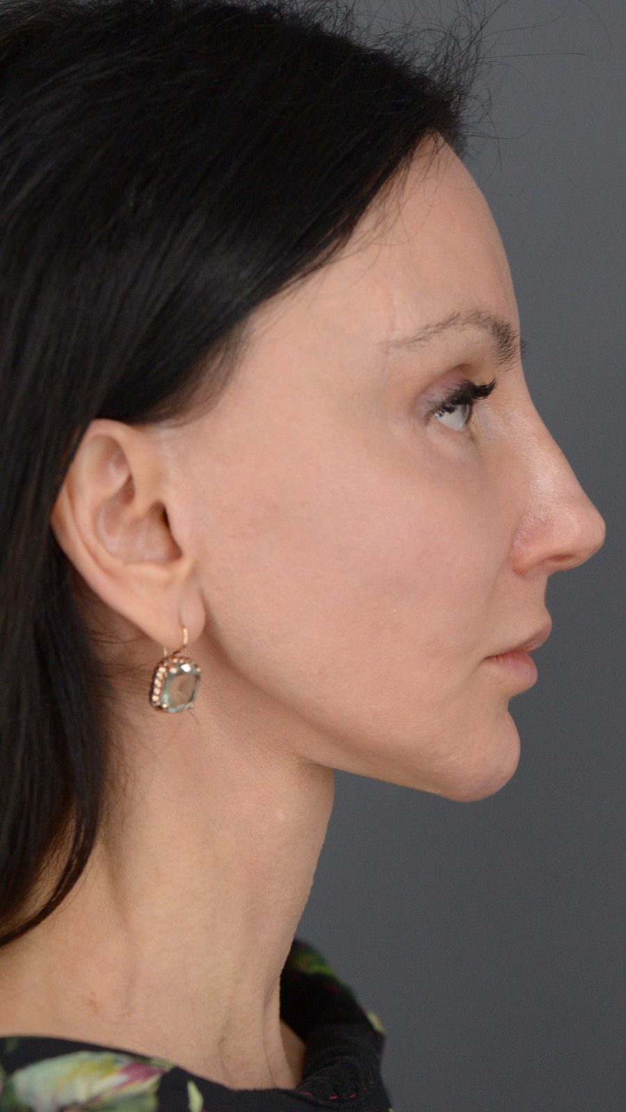 Ponytail Facelift before and after, case 15, view 5 (after)