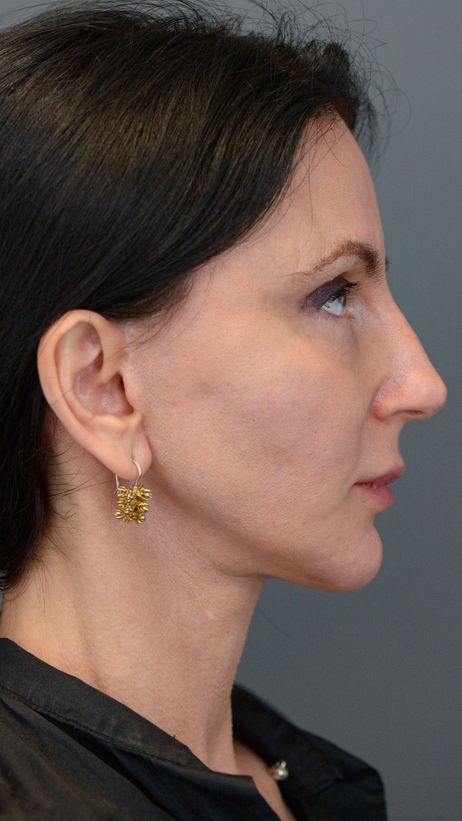 Ponytail Facelift before and after, case 15, view 5 (before)