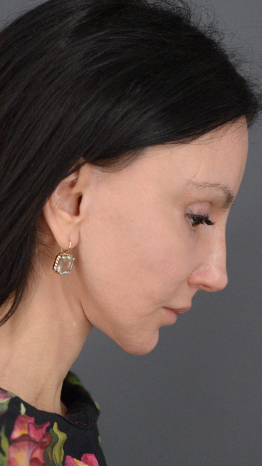 Ponytail Facelift before and after, case 15, view 6 (after)
