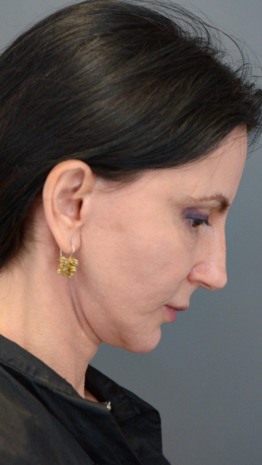 Ponytail Facelift before and after, case 15, view 6 (before)