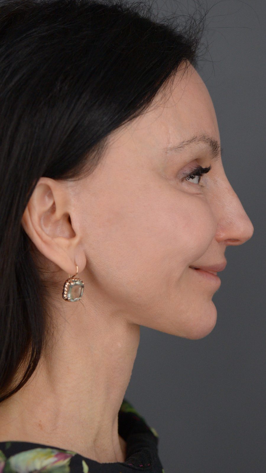 Ponytail Facelift before and after, case 15, view 7 (after)