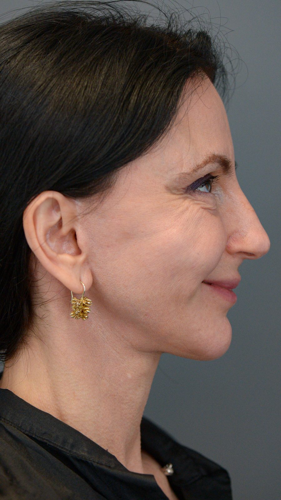 Ponytail Facelift before and after, case 15, view 7 (before)