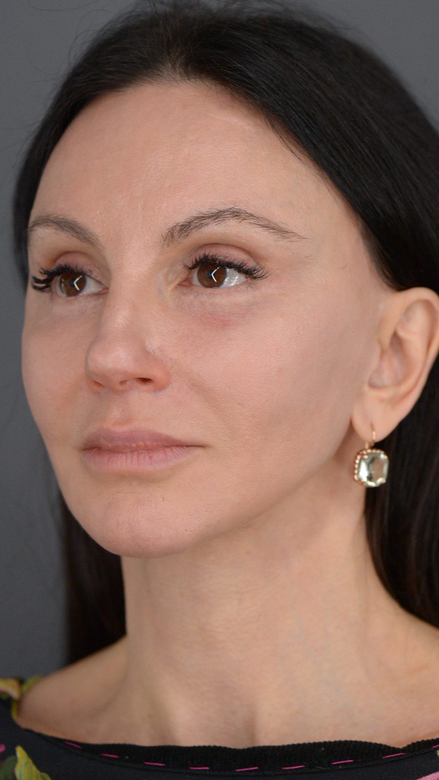 Ponytail Facelift before and after, case 15, view 8 (after)