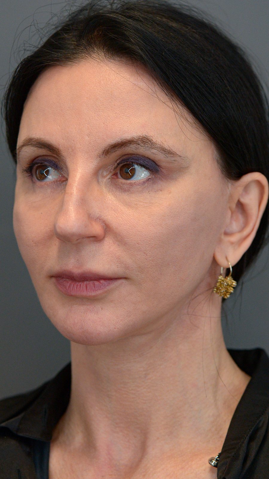 Ponytail Facelift before and after, case 15, view 8 (before)