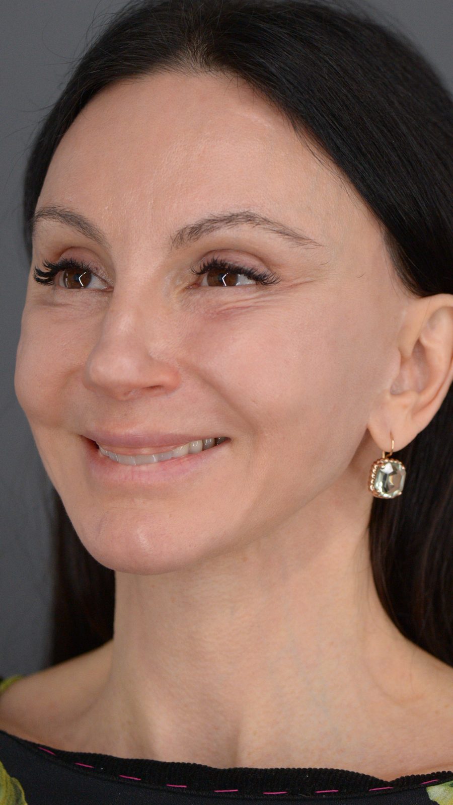 Ponytail Facelift before and after, case 15, view 9 (after)
