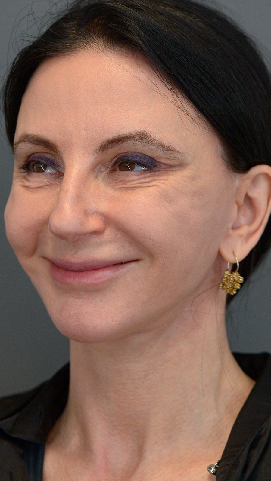 Ponytail Facelift before and after, case 15, view 9 (before)