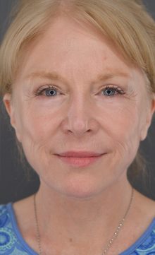 Ponytail Facelift before and after, case 16 (after)