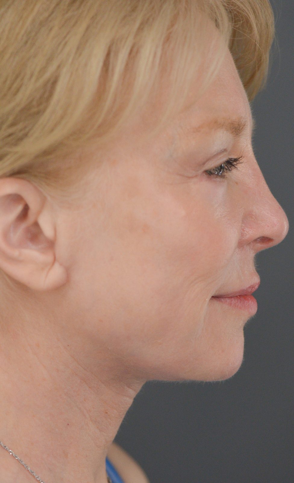 Ponytail Facelift before and after, case 16, view 3 (after)