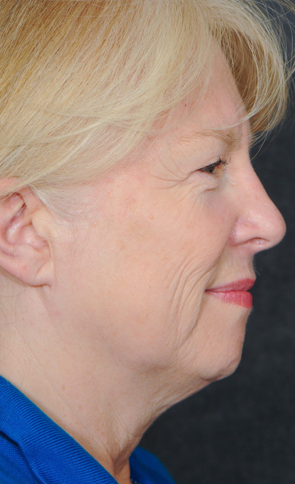 Ponytail Facelift before and after, case 16, view 3 (before)