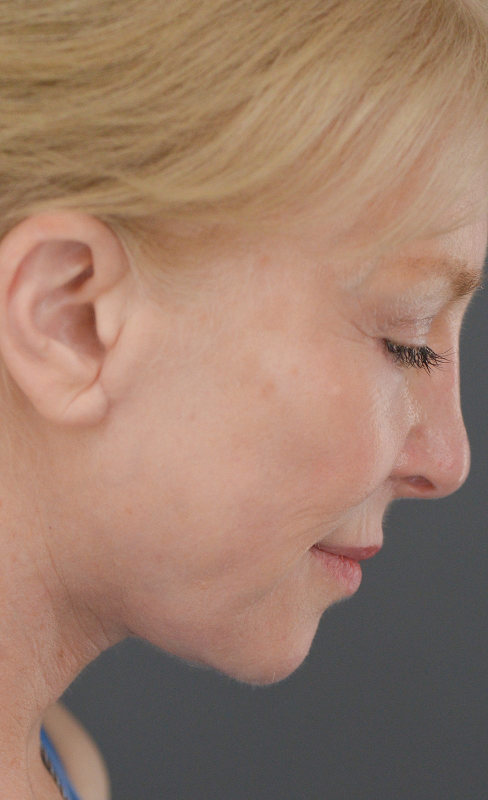 Ponytail Facelift before and after, case 16, view 4 (after)