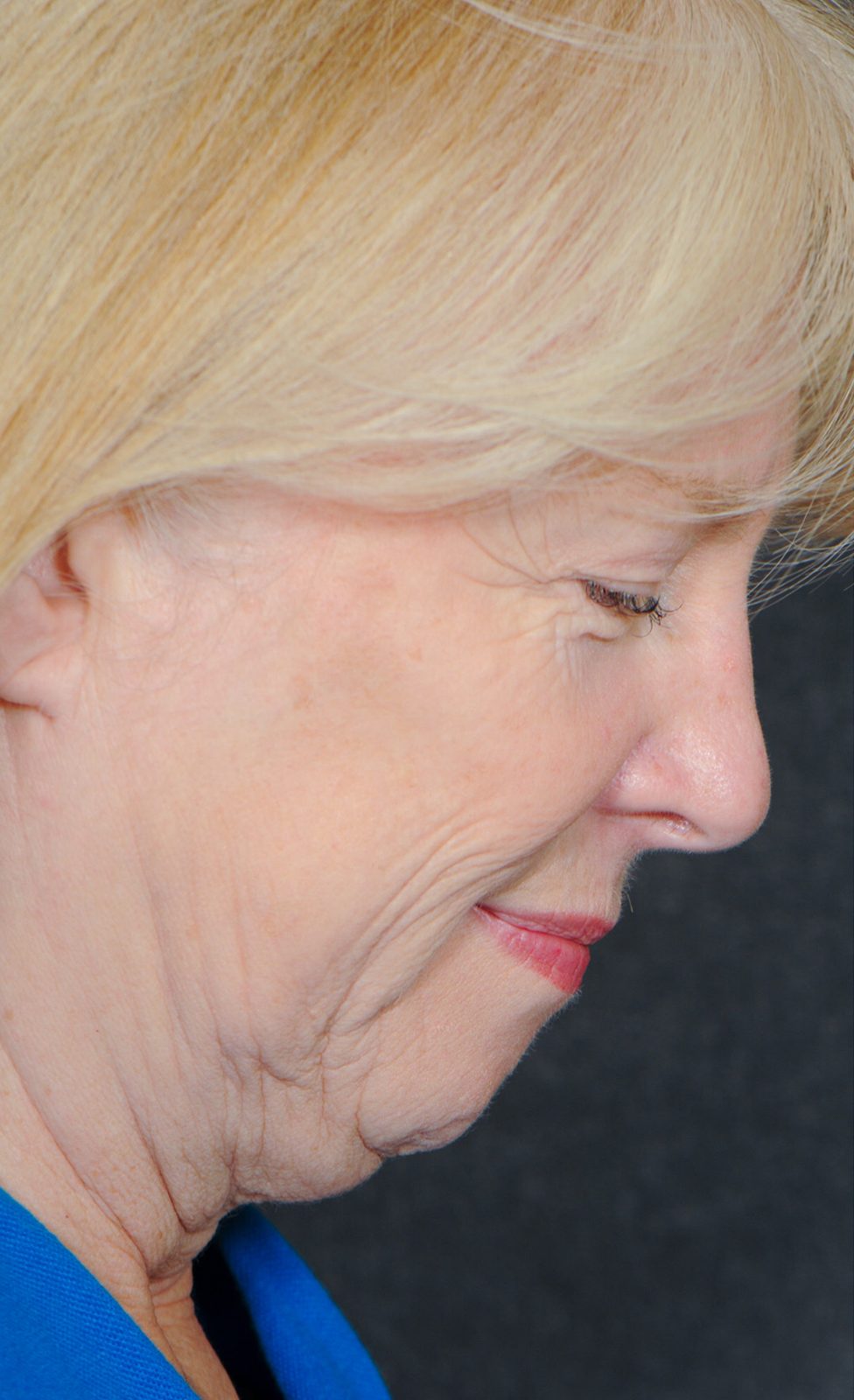 Ponytail Facelift before and after, case 16, view 4 (before)