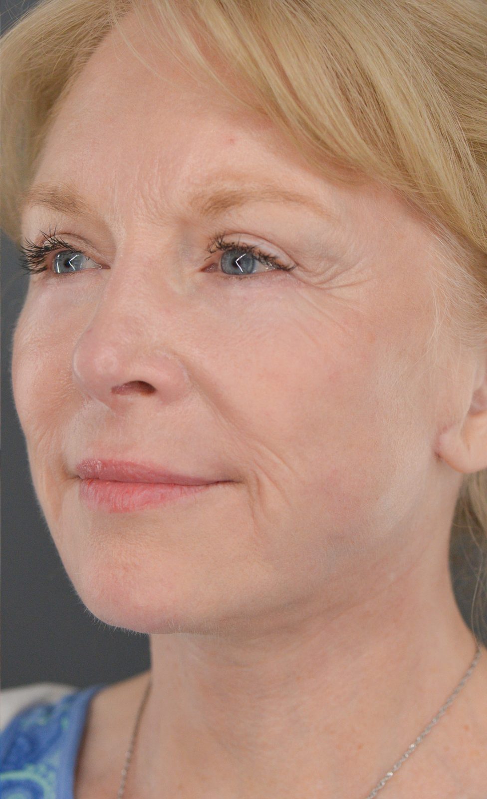 Ponytail Facelift before and after, case 16, view 5 (after)
