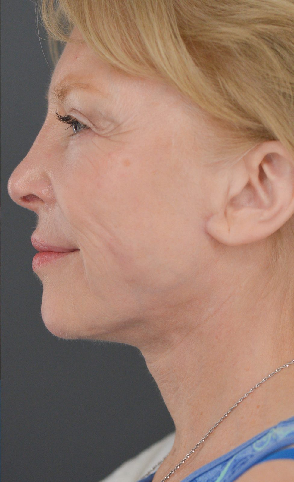 Ponytail Facelift before and after, case 16, view 6 (after)