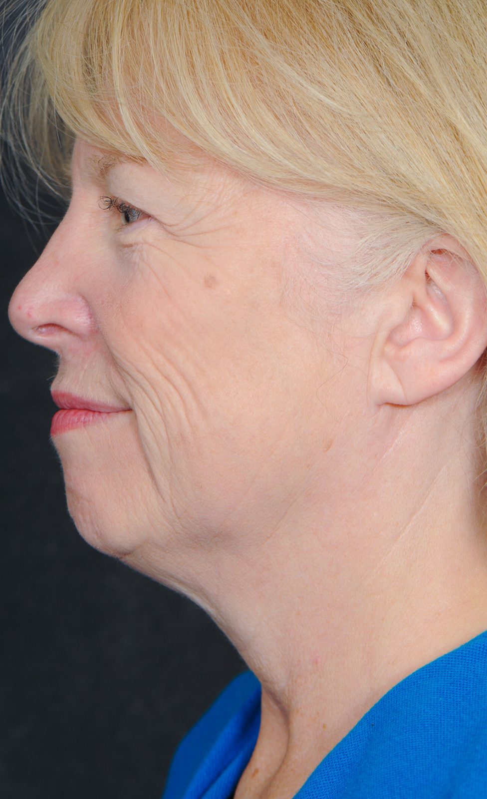Ponytail Facelift before and after, case 16, view 6 (before)