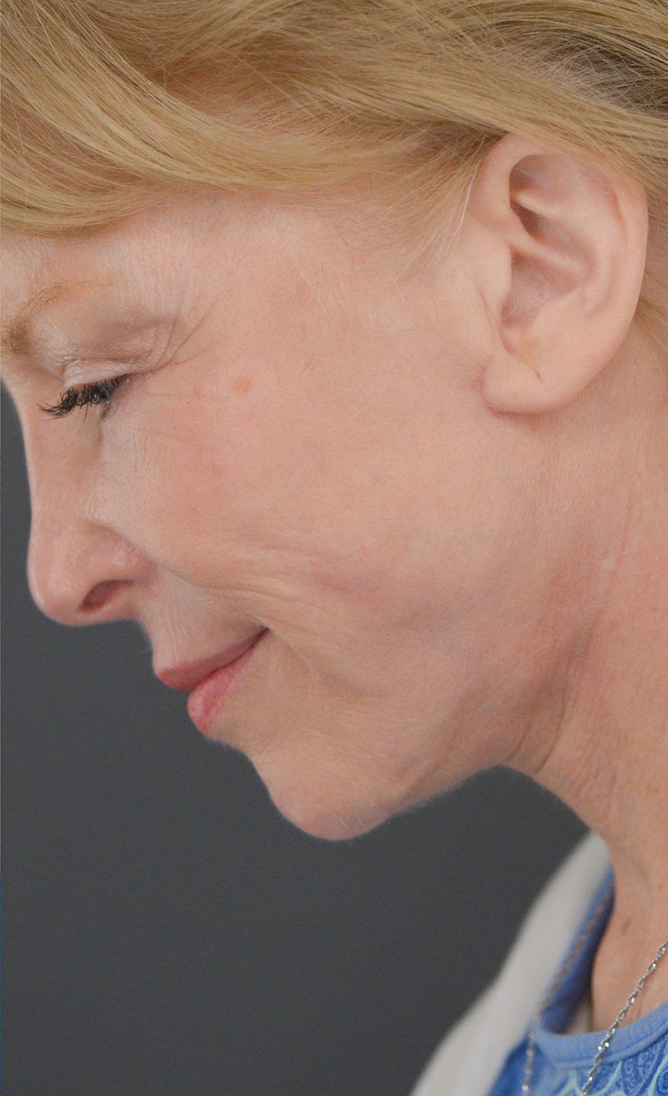 Ponytail Facelift before and after, case 16, view 7 (after)