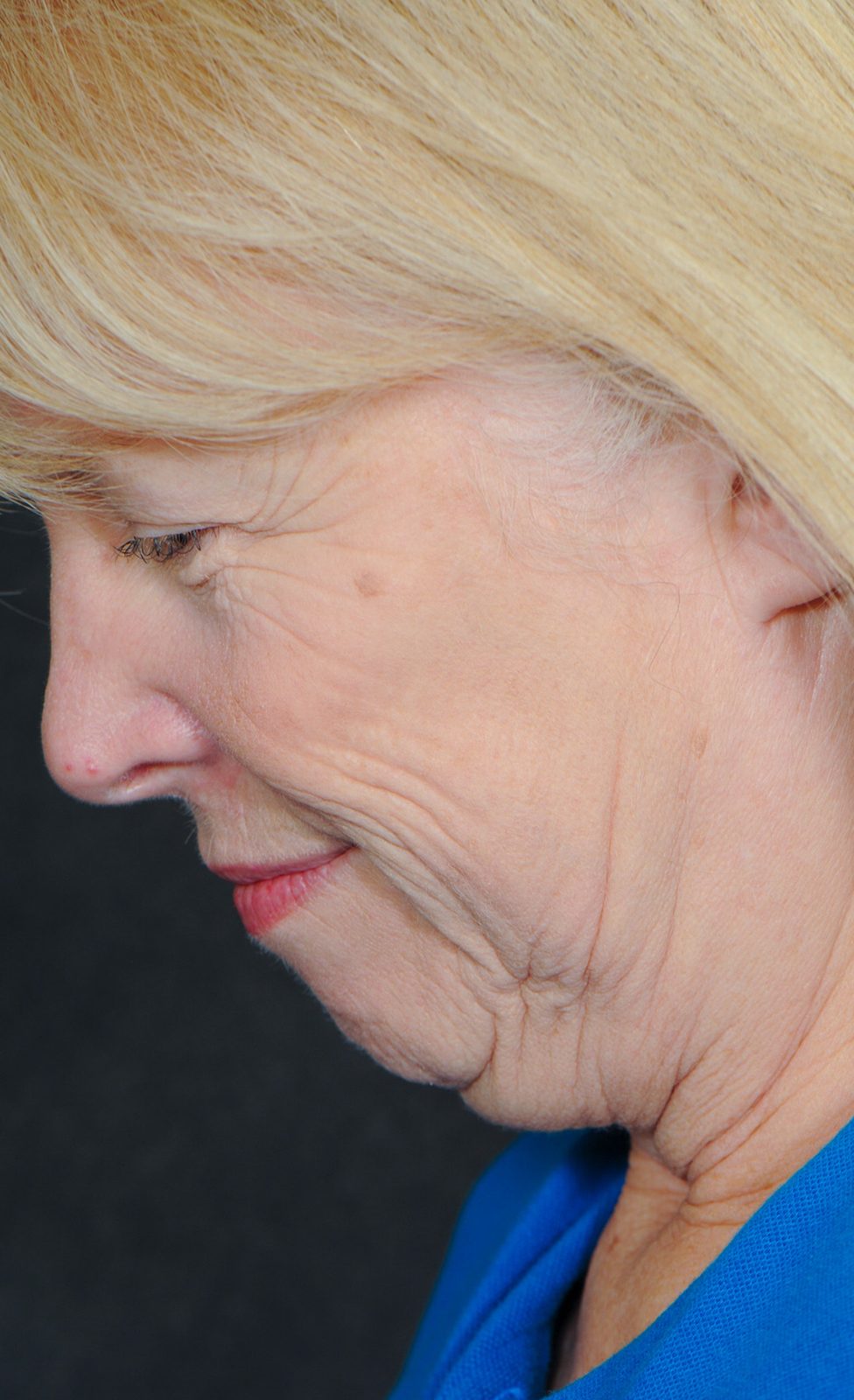 Ponytail Facelift before and after, case 16, view 7 (before)