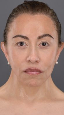 Ponytail Facelift before and after, case 17 (after)
