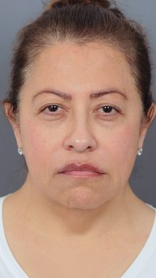 Ponytail Facelift before and after, case 17 (before)
