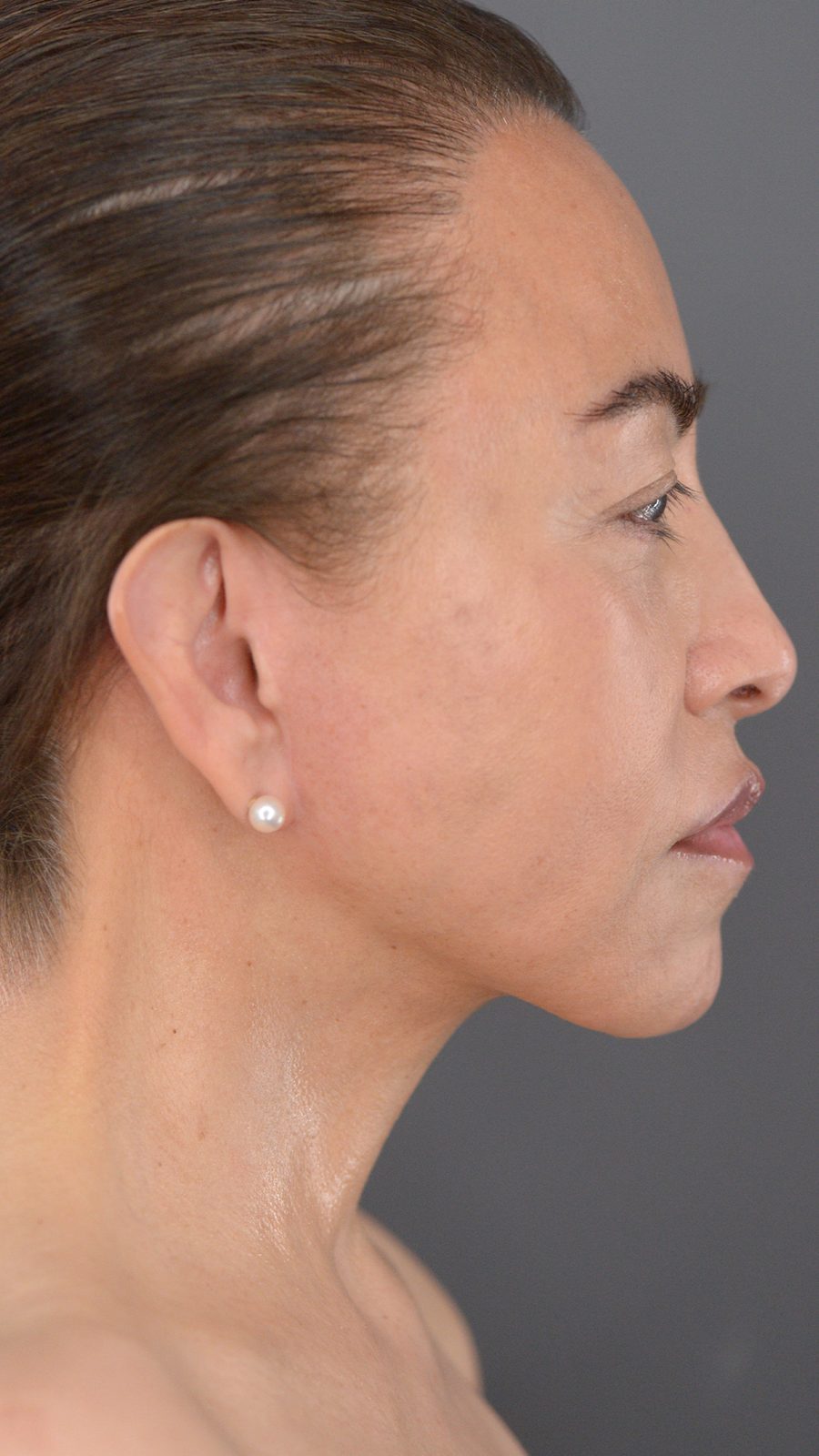 Ponytail Facelift before and after, case 17, view 3 (after)
