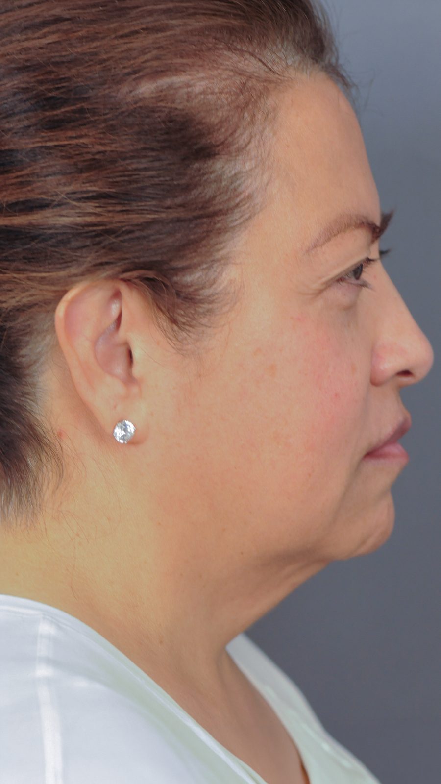 Ponytail Facelift before and after, case 17, view 3 (before)