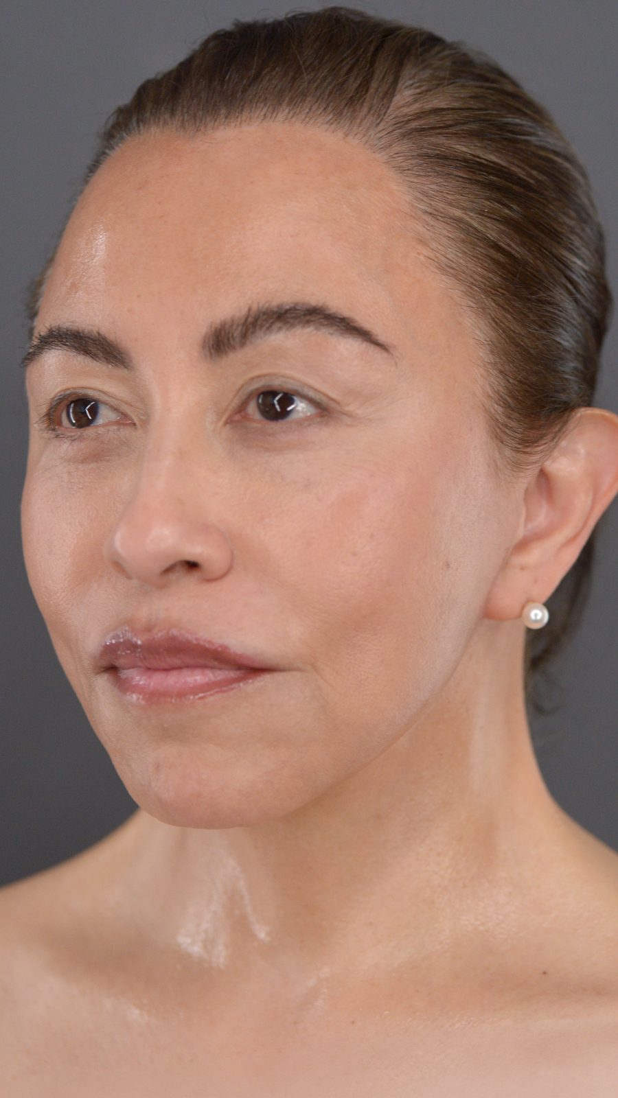 Ponytail Facelift before and after, case 17, view 5 (after)