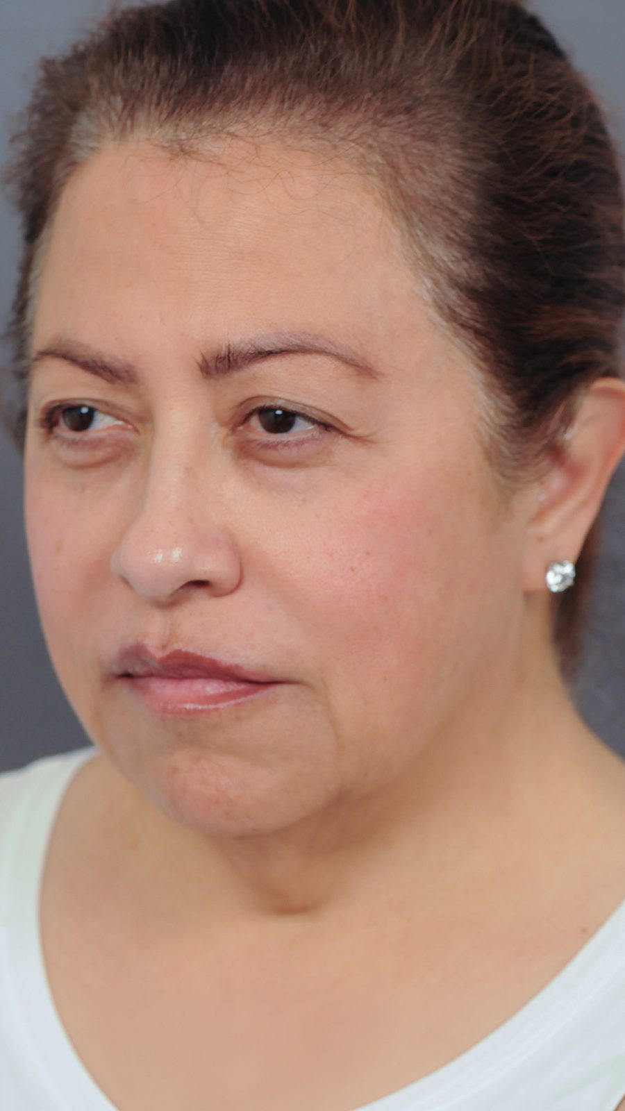 Ponytail Facelift before and after, case 17, view 5 (before)