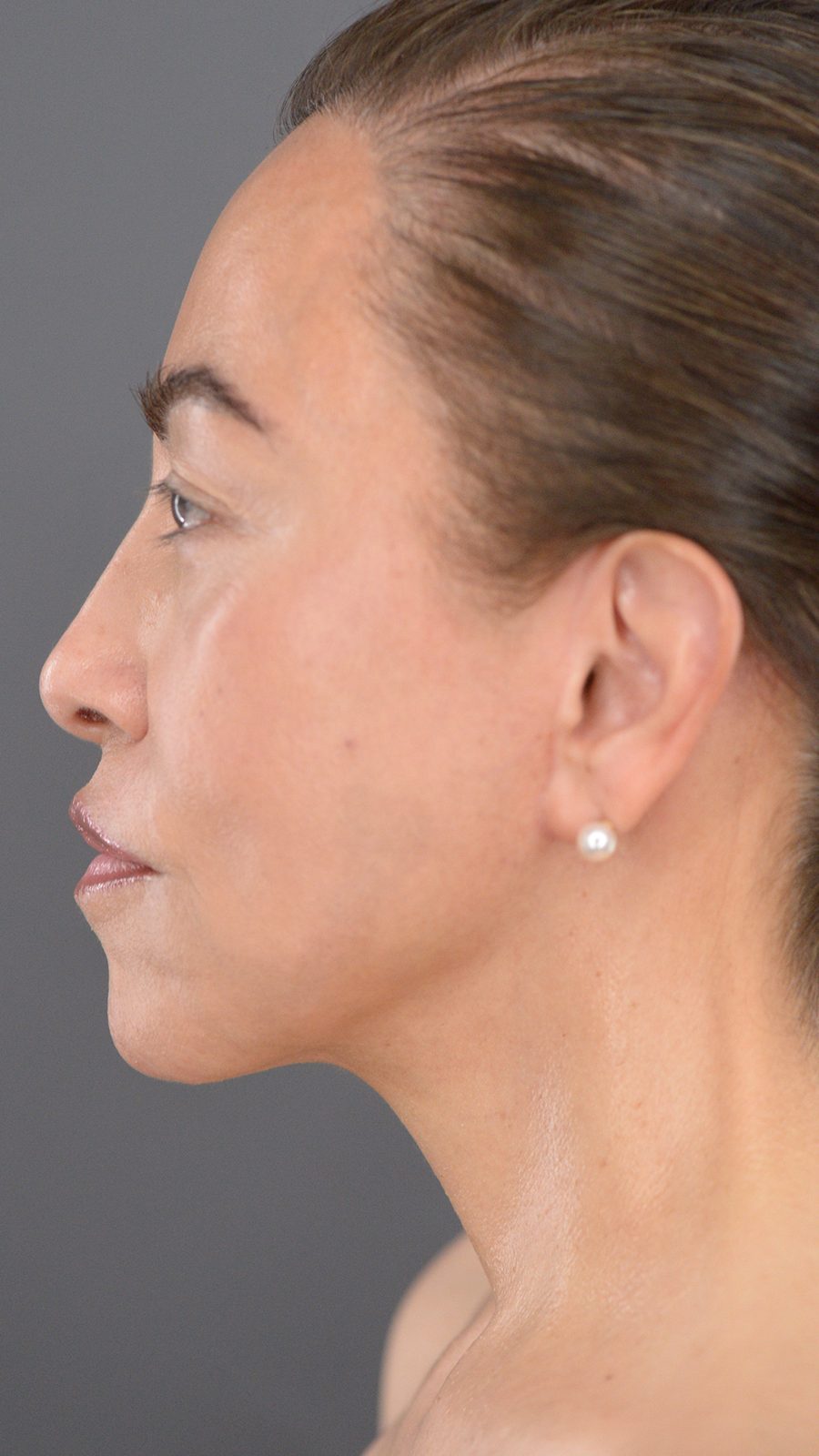 Ponytail Facelift before and after, case 17, view 6 (after)