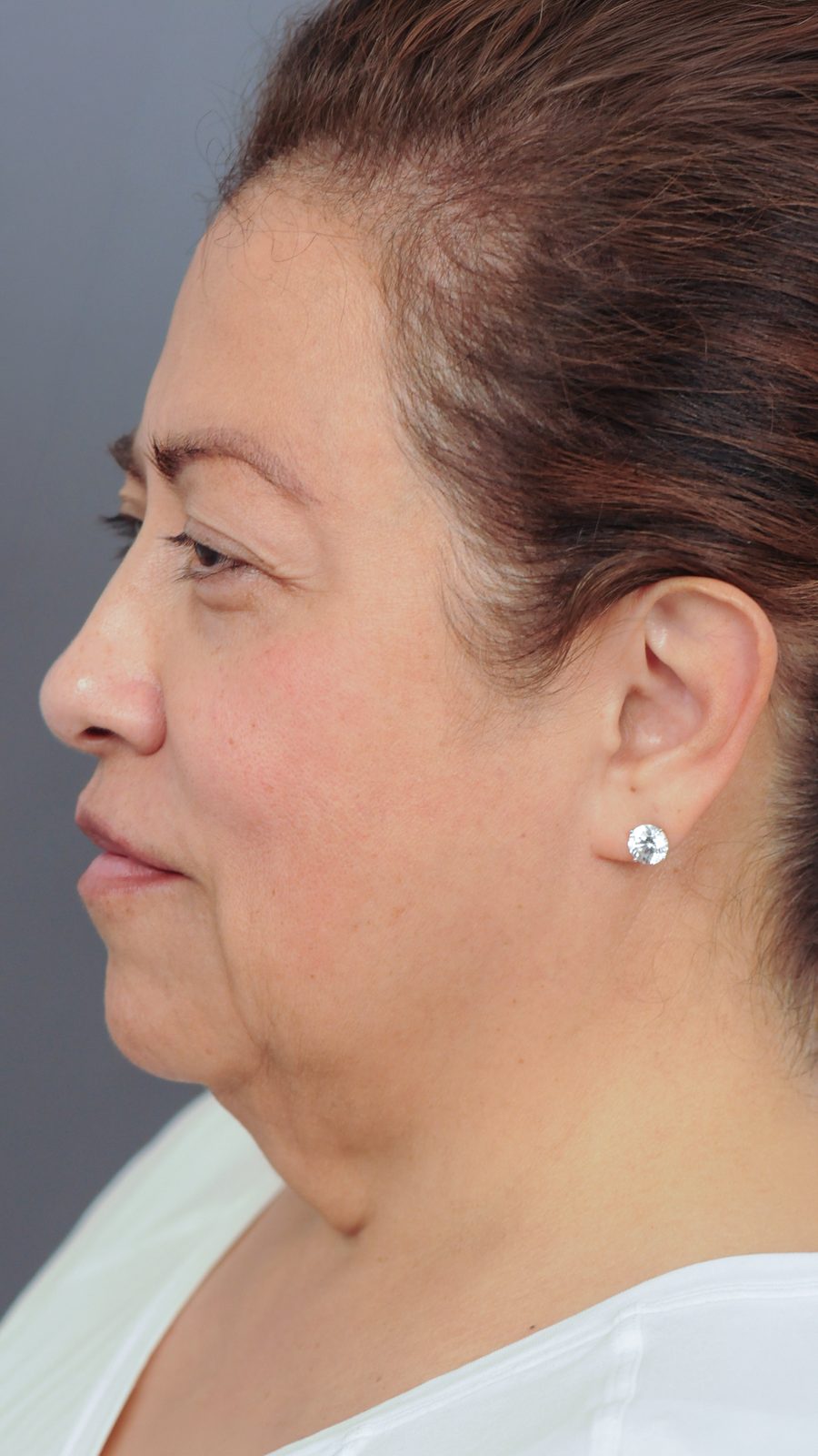Ponytail Facelift before and after, case 17, view 6 (before)