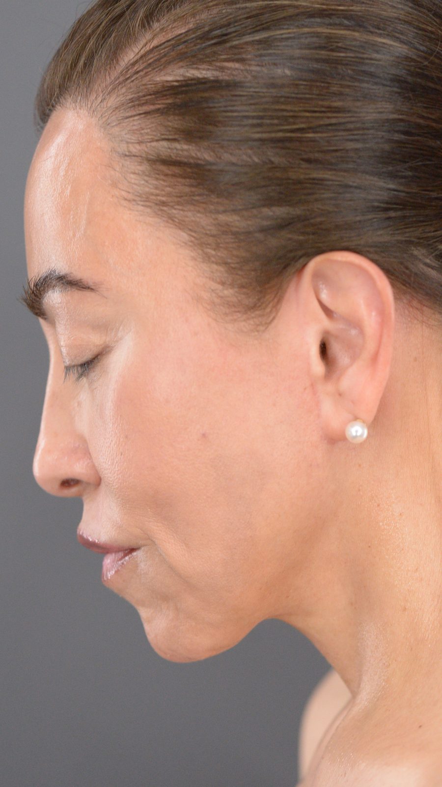Ponytail Facelift before and after, case 17, view 7 (after)