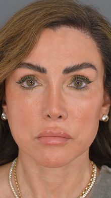 Ponytail Facelift before and after, case 18 (after)