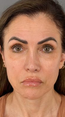 Ponytail Facelift before and after, case 18 (before)