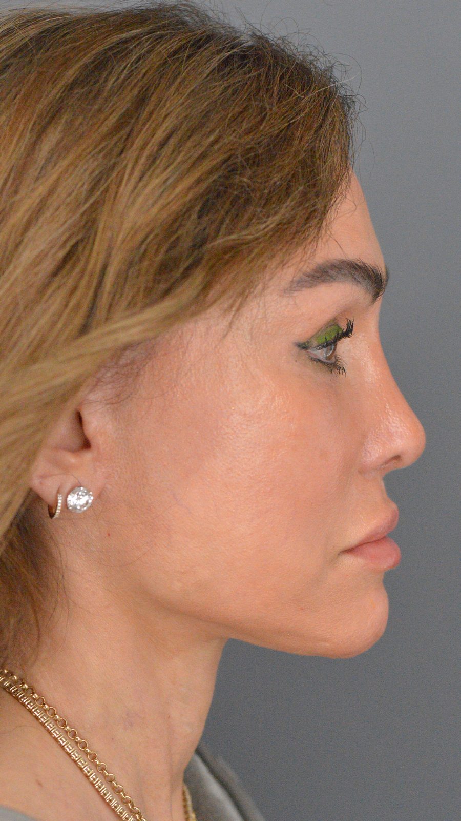 Ponytail Facelift before and after, case 18, view 3 (after)