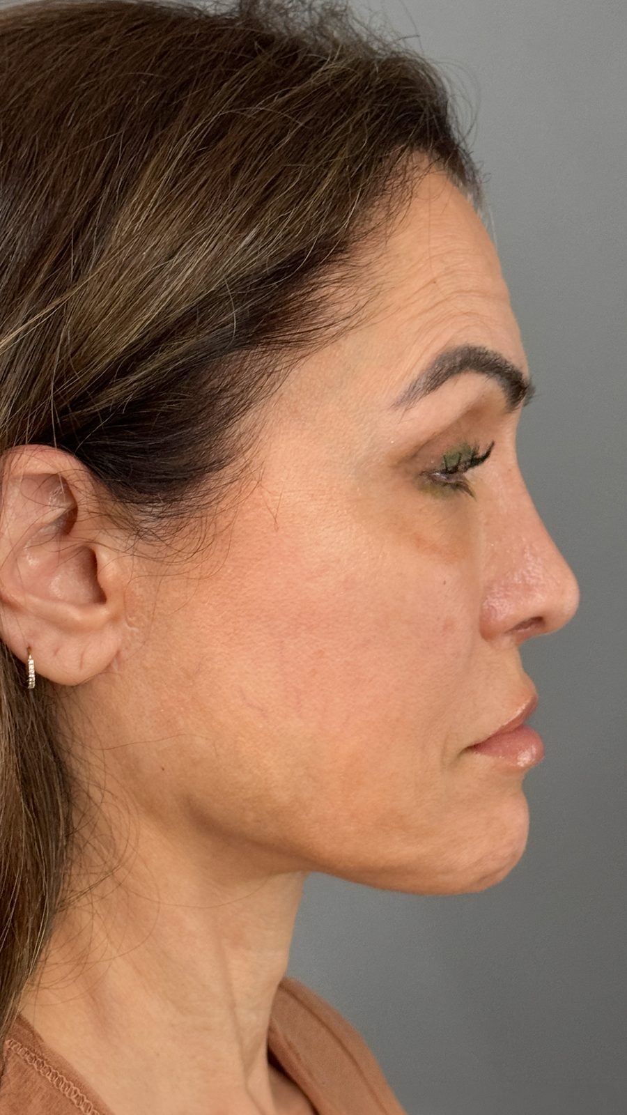 Ponytail Facelift before and after, case 18, view 3 (before)