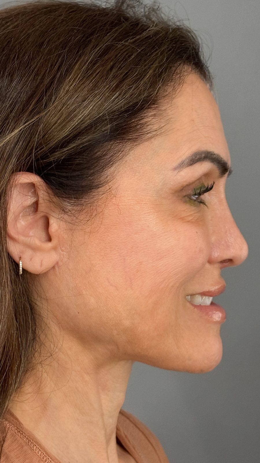 Ponytail Facelift before and after, case 18, view 5 (before)