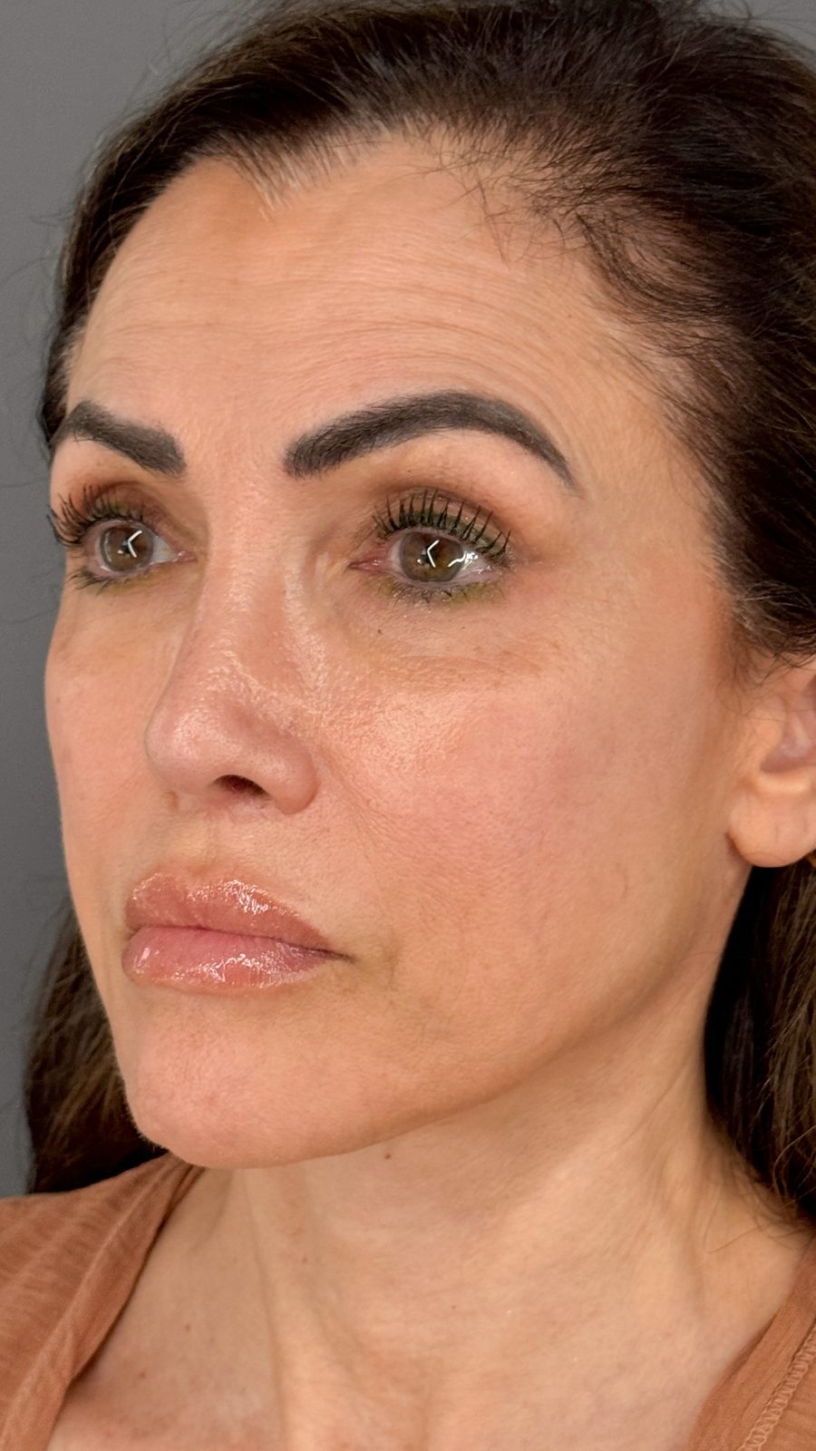 Ponytail Facelift before and after, case 18, view 6 (before)