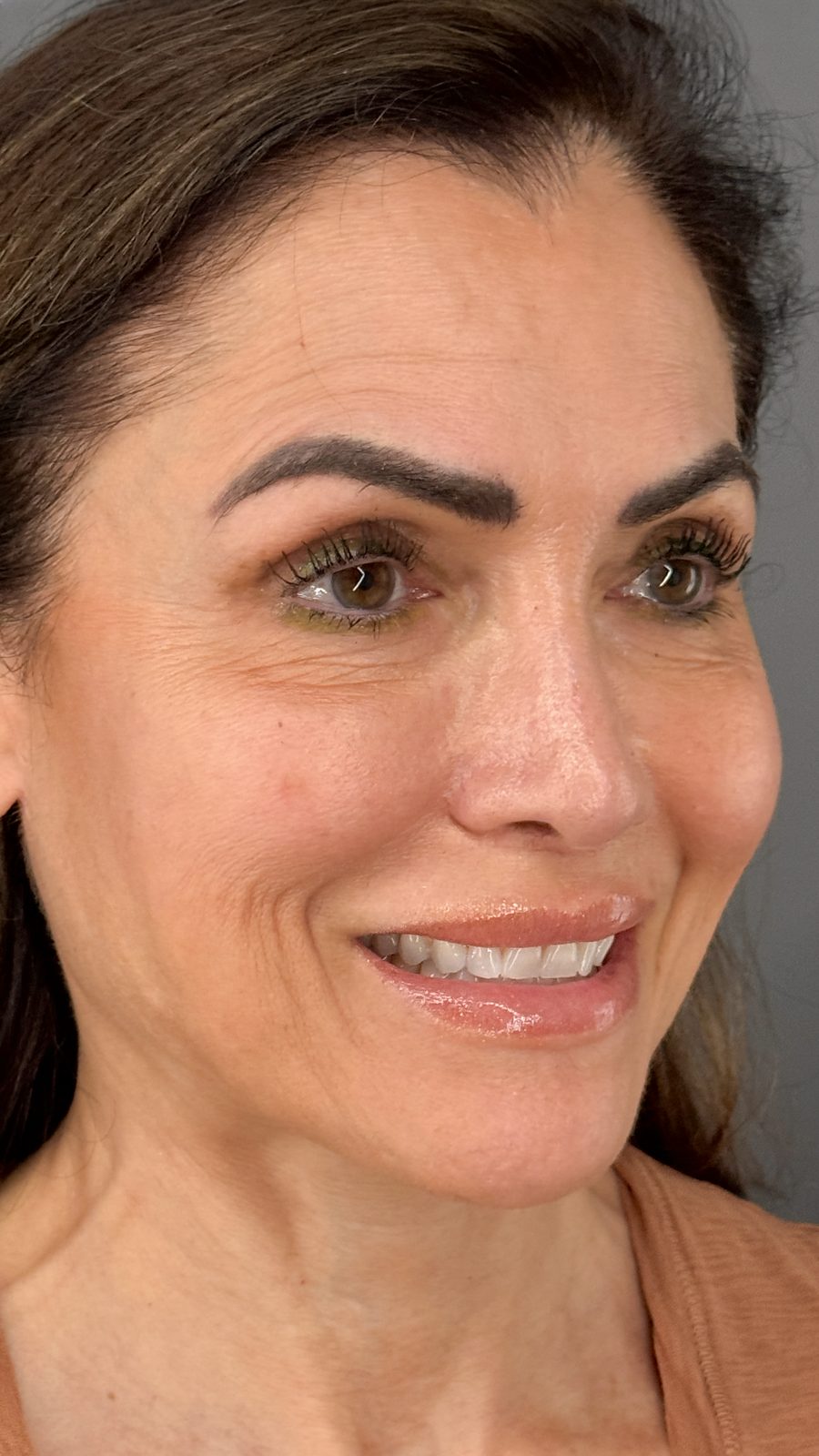 Ponytail Facelift before and after, case 18, view 7 (before)