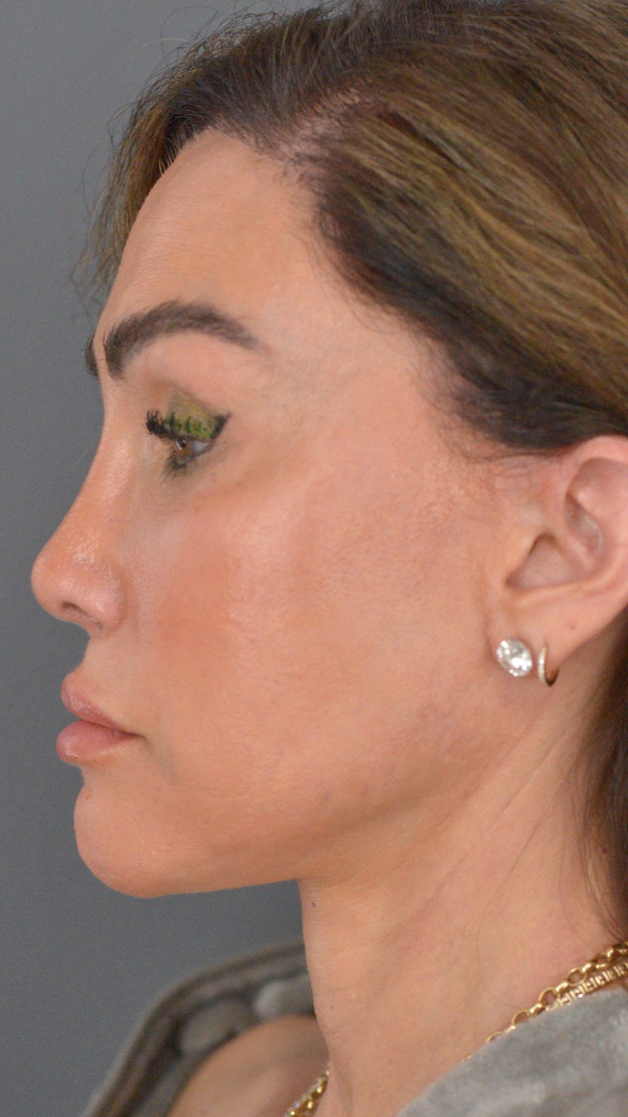 Ponytail Facelift before and after, case 18, view 9 (after)