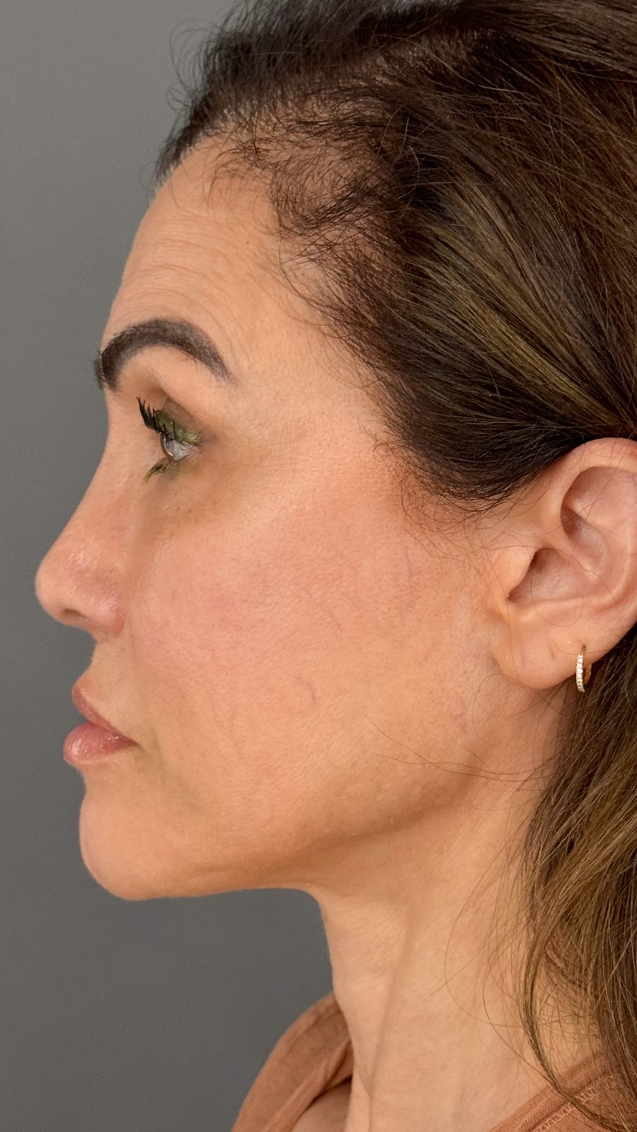 Ponytail Facelift before and after, case 18, view 9 (before)
