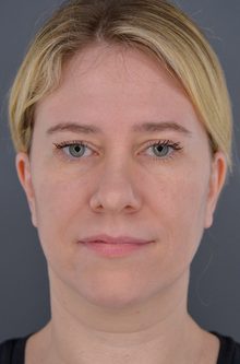 Ponytail Facelift before and after, case 19 (before)
