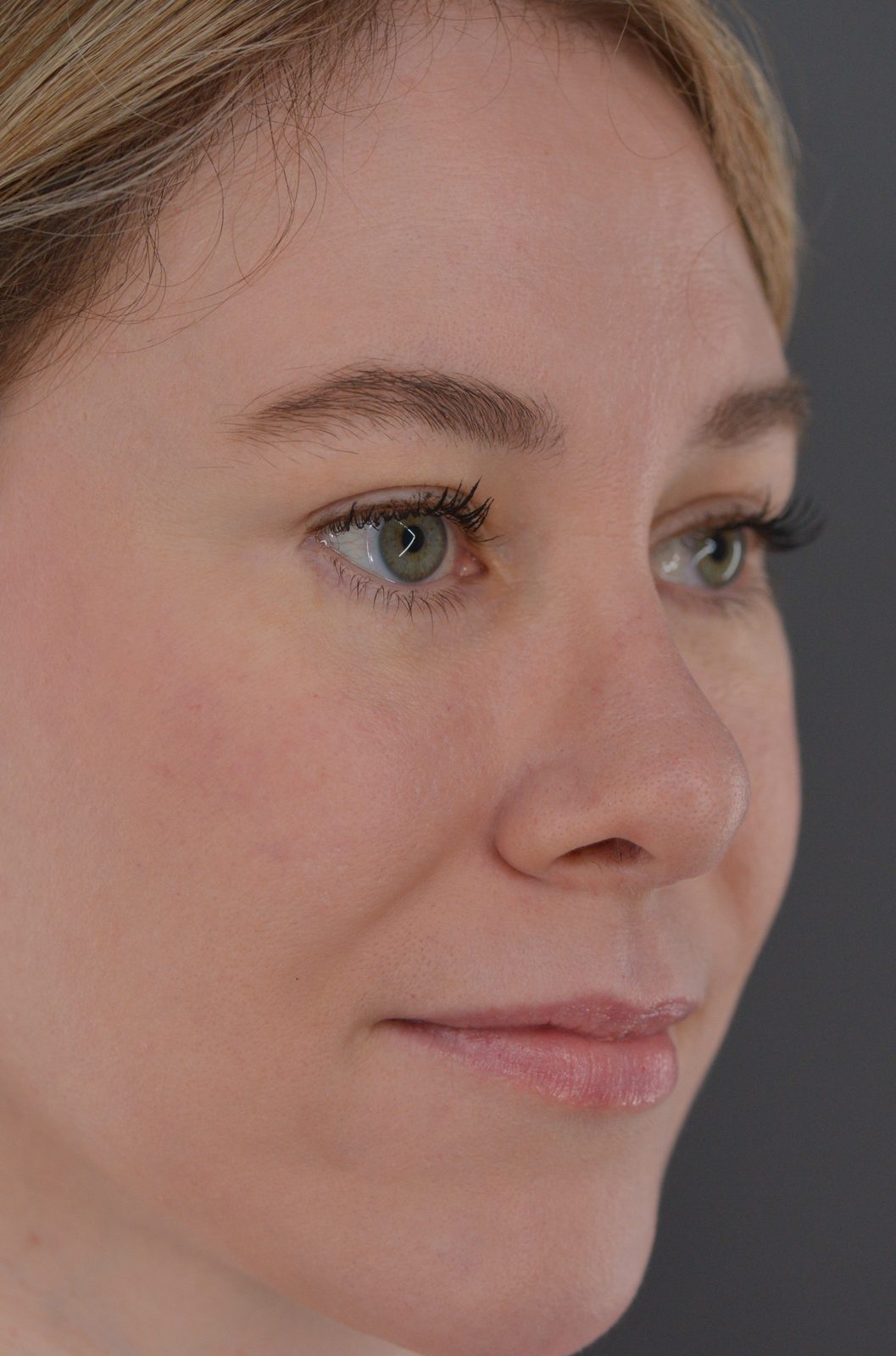 Ponytail Facelift before and after, case 19, view 3 (after)