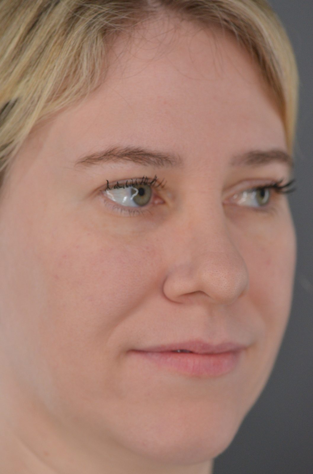 Ponytail Facelift before and after, case 19, view 3 (before)