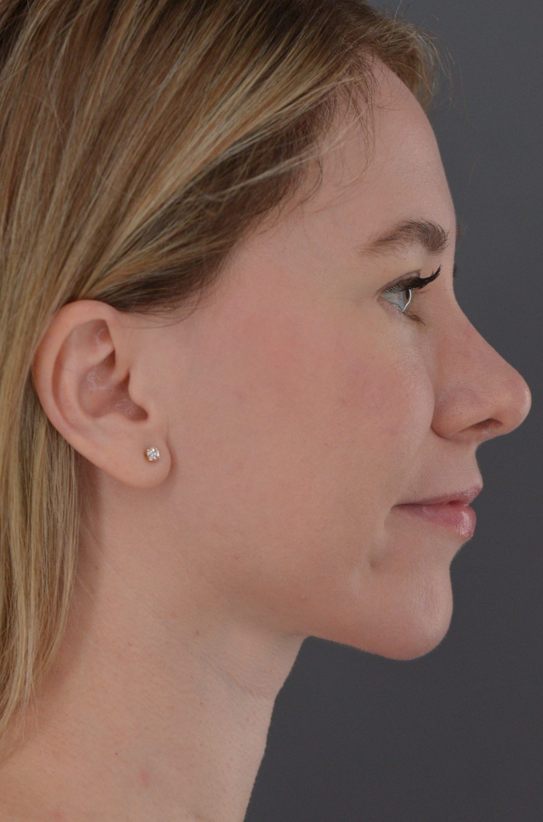 Ponytail Facelift before and after, case 19, view 4 (after)