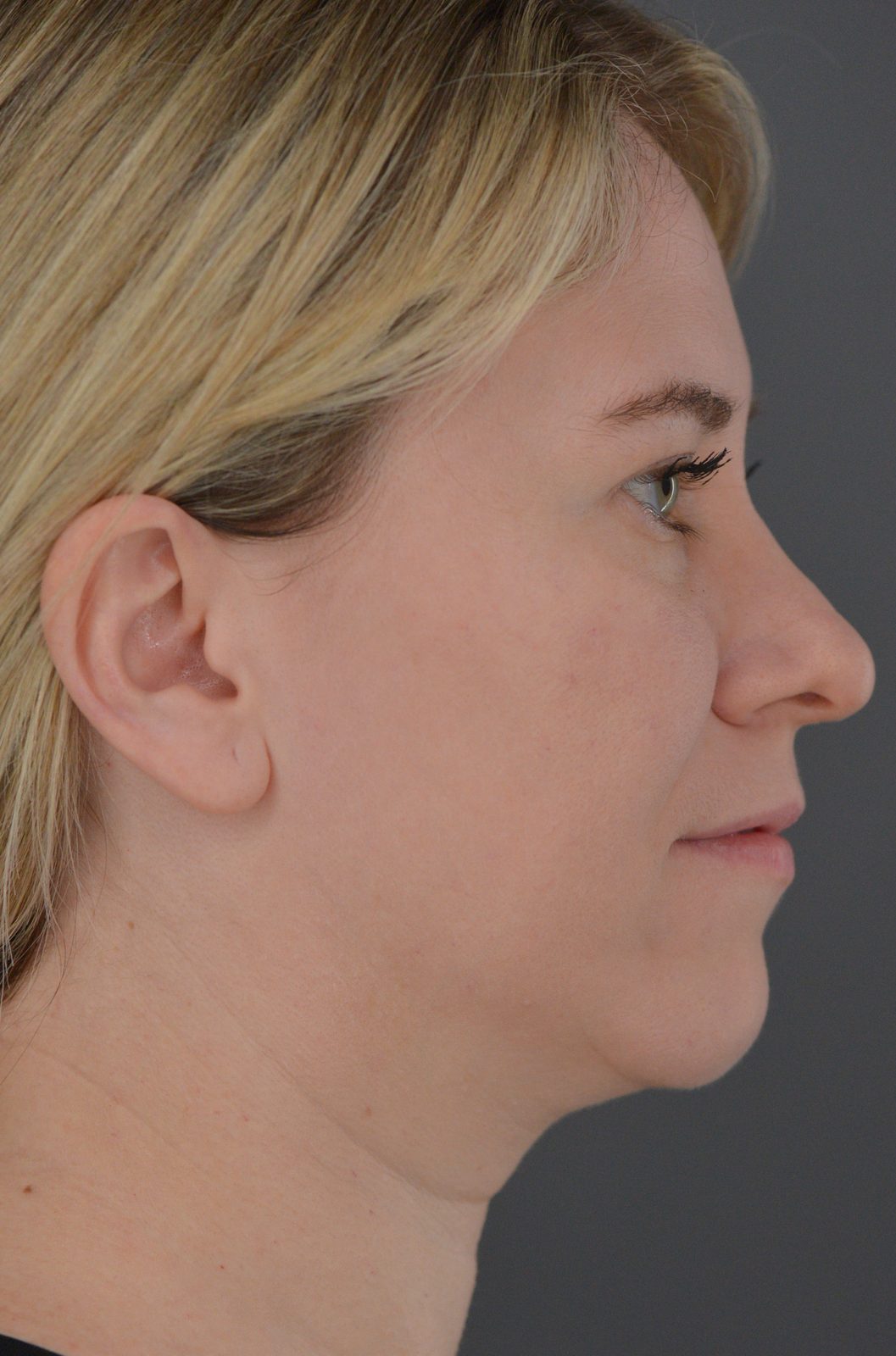 Ponytail Facelift before and after, case 19, view 4 (before)